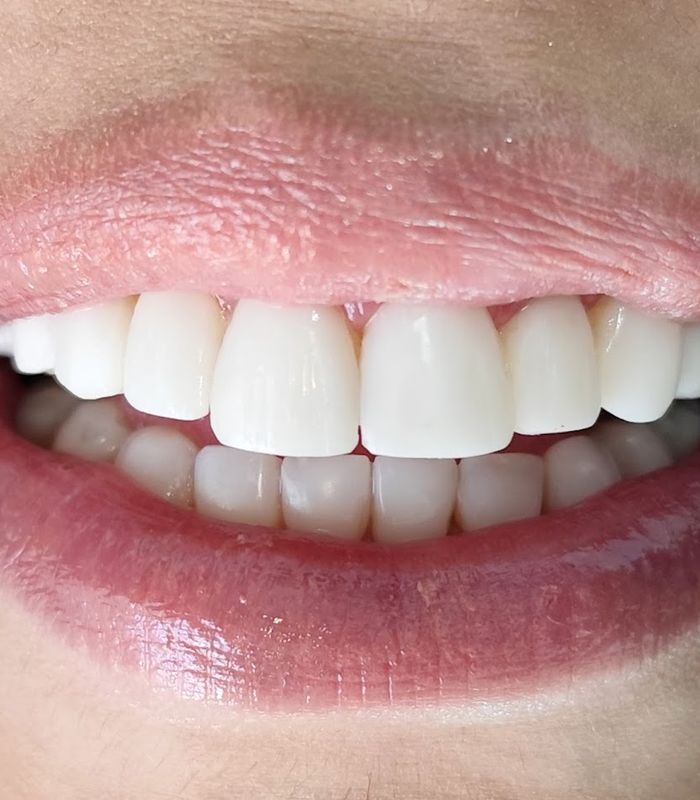 Resultado real de diseño de sonrisa en Odonto Master